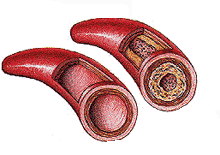 Blood Clots & HDL/LDL